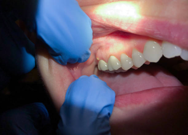 Best Dentist for Tooth Abscess  in North Lewisburg, OH